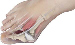 Bunion Surgery