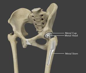 Revision Hip Replacement RHR