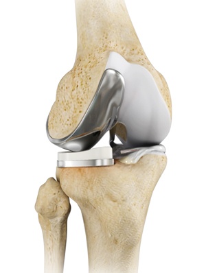 Unicondylar (Unicompartmental) Knee Replacement