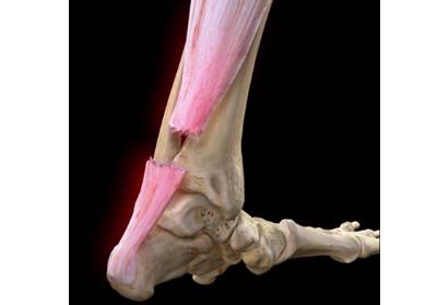 Achilles Tendon- Repair