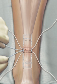 Achilles Tendon Repair