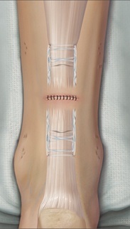 Achilles Tendon Repair