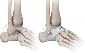 Ankle Ligament Injury