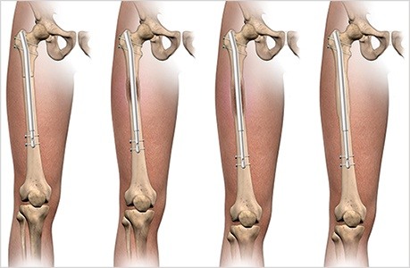 Femur Sequence