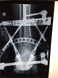 Charcot Foot