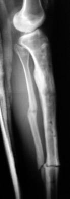 Fracture/ Late Deformity