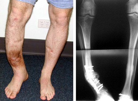 Post - Traumatic Bone Deformities