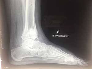 Case study of a patient with a fracture complication from diabetes that had the external fixateur applied and the deformity gradually corrected with staged bone grafting- the fixateur was removed after three months with the fracture healed in an anatomical position