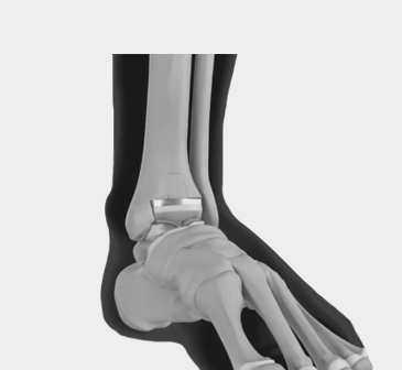 Total Ankle Replacement