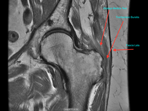 PRECICE  Lengthening Nail 